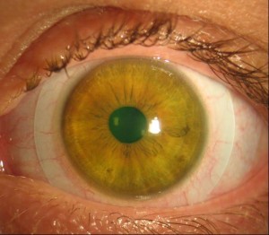 Scleral Contact Lens (1)