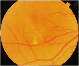 Branch-Retinal-Artery-Occlusion