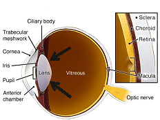 CataractsDiagram