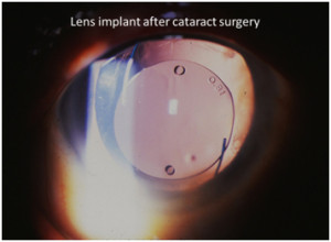 Lens Implant