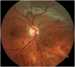Retinal-Detachment
