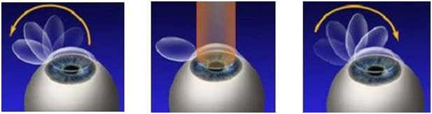 Lasik Surgery Image