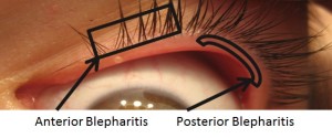 Anterior and Posterior Blepharitis