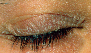 Seborrheic Blepharitis