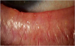 Ulcerative Blepharitis