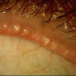 Meibomian Gland Disease