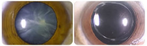 cataract before and after