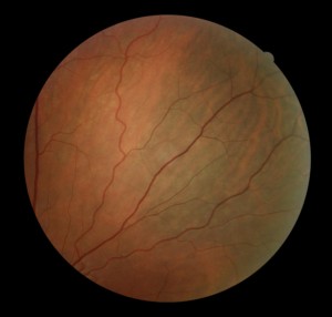 ocular melanocytosis