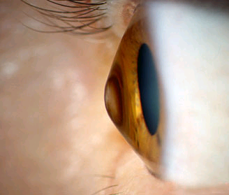 keratoconus