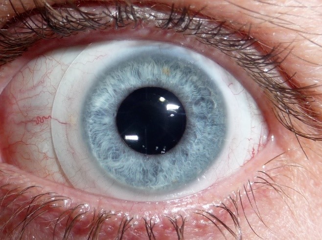 scleral contact lenses